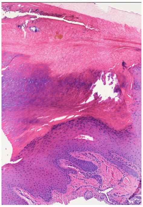 Histopathology of onychopapilloma (patient number 5). The nail bed ...