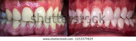 Full Mouth Veneers Stock Photo (Edit Now) 1253379829