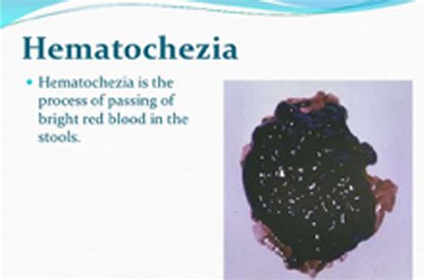 Hematochezia