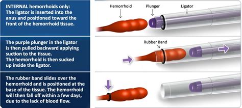 Hemorrhoid Banding - Atlanta Gastroenterology Associates (North GA)