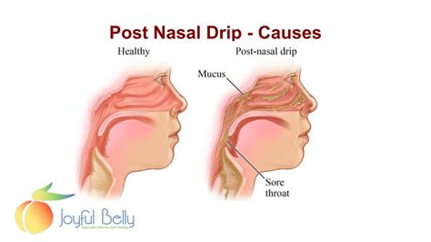 How To Fix Post Nasal Drip » Sailsilly