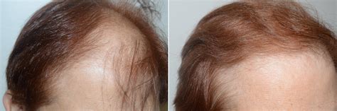 Hair Transplants for Women photos | Miami, FL | Patient59153