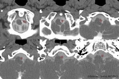 Roentgen Ray Reader: Vertebrobasilar Dolichoectasia