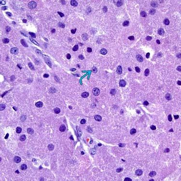 Granular Cell Tumor Histology