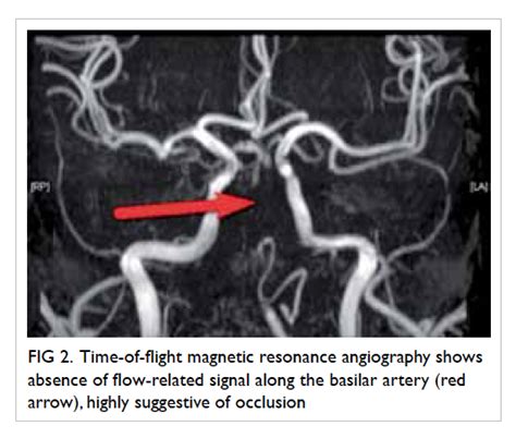 Acute basilar artery occlusion: an easily missed uncommon but devastating emergency | HKMJ