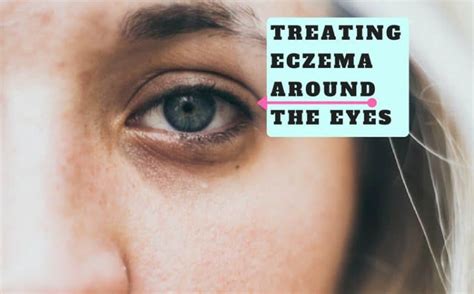 Treating Eczema Around The Eyes (Natural Remedies) | How to treat ...