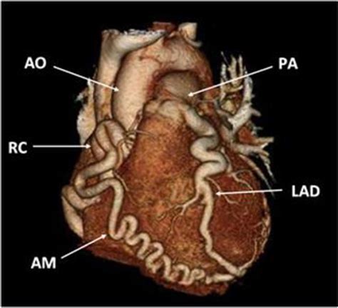 CTA 3D reconstruction of the heart. Aorta (AO), Right c | Open-i