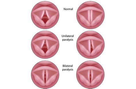 Laryngeal paralysis — Elwood vet