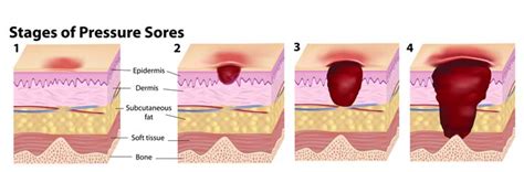 The Prevention of Pressure Ulcers - Mangar UK