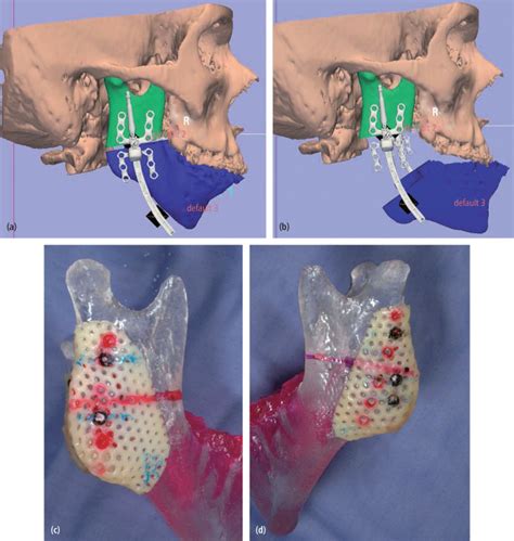 6 Distraction Osteogenesis | Pocket Dentistry