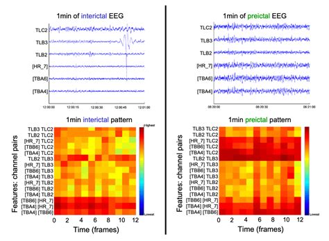 Classification of patterns of EEG synchronization for seizure ...