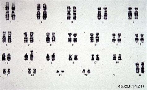 Translocation Down Syndrome Karyotype