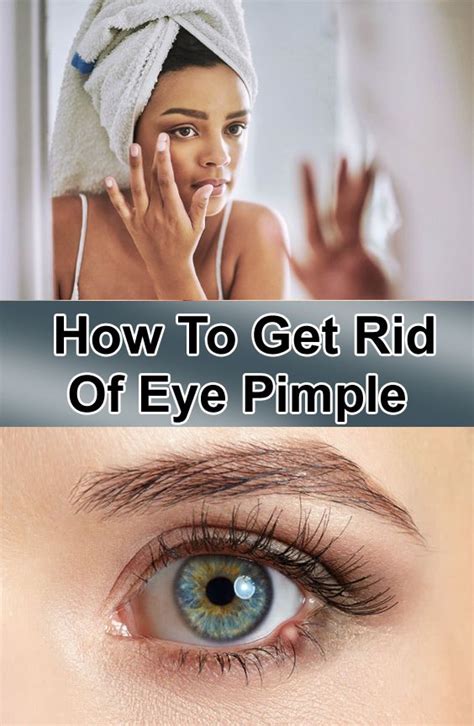 How To Get Rid Of Eye Pimple | Pimples, Eye stye remedies, Small pimples