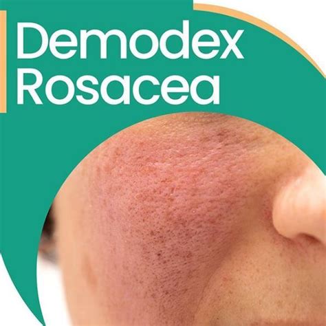 How to treat Demodex rosacea? Ungex aims to eliminate mites with its ...