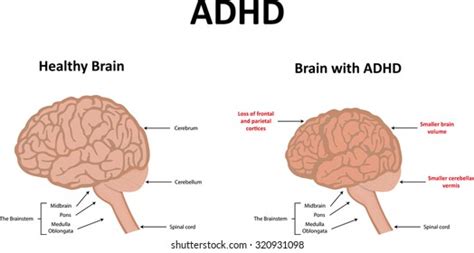 Adhd Brain Images, Stock Photos & Vectors | Shutterstock