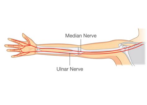 Ulnar Nerve Surgery Failure