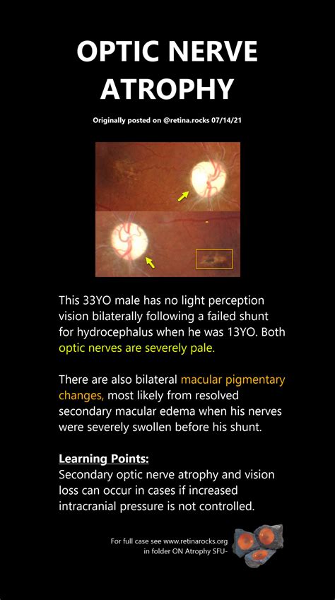 Optic Nerve Disorders > Optic Nerve Atrophy - Retina Rocks