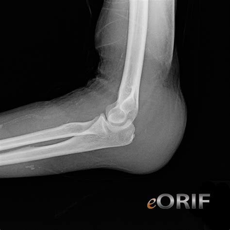 Olecranon Bursitis M70.20 726.33 | eORIF