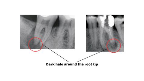 The telltale signs of failed root canal with X-ray pictures