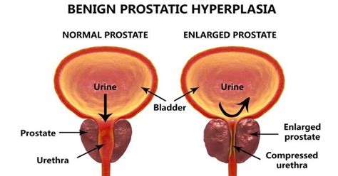 What is Enlarged Prostate - Causes, Symptoms, Treatment, and More