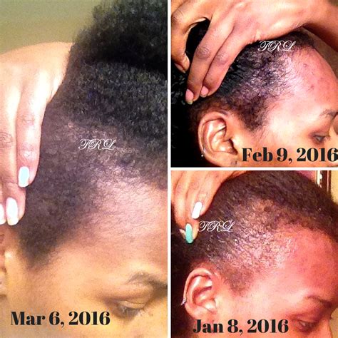 Pin on TRL Users & Hair Growth Journeys