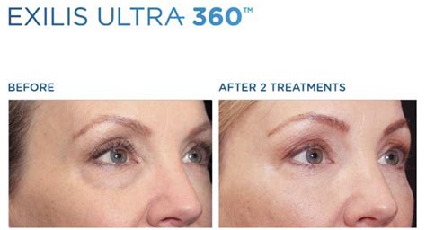 Exilis ultra before and after - Delray Dermatology + Cosmetic Center ...