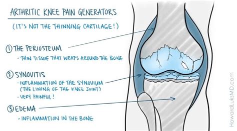 Osteoarthritis and Running …Can They Co-Exist? – Howard J. Luks, MD