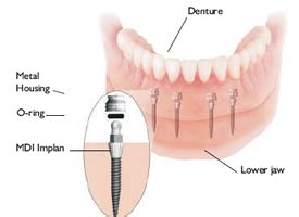 Mini Dental Implants - Procedure Information And Costs