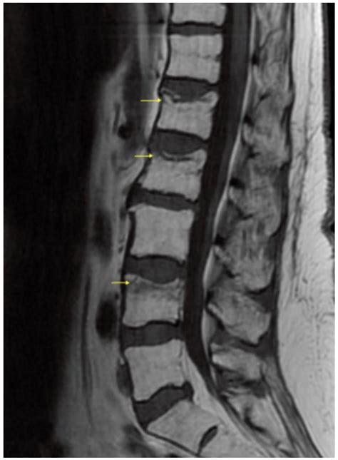 Compression Fracture