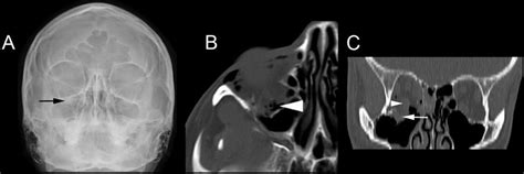 Blow-out fracture in a 29 year old woman. A 'teardrop' sign ...