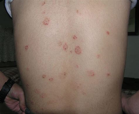 Pityriasis Rosea - Causes, Rash, Herald Patch, Stages, Treatment