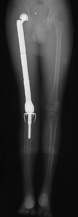 A total Femoral endoprosthetic replacement | Download Scientific Diagram