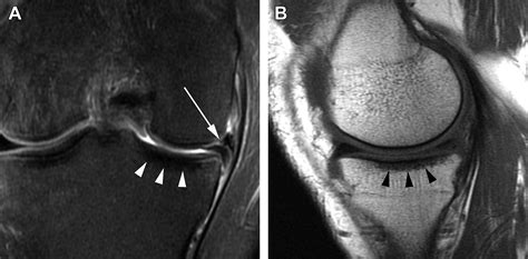 The relationship between subchondral sclerosis detected with MRI and cartilage loss in a cohort ...