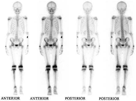 Abnormal Bone Scan