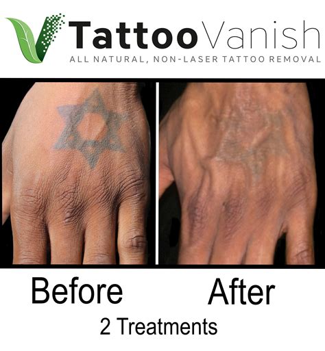 Tattoo Removal Twin Cities - All-Natural, Non-Laser Tattoo Removal