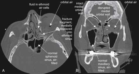 Imaging the Face | Radiology Key