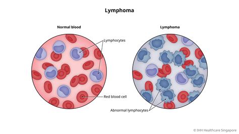 Lymphoma - Symptoms & Causes | Gleneagles Hospital