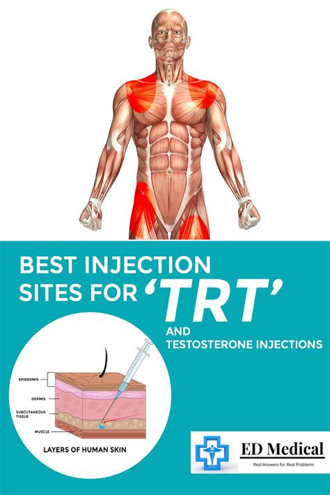 Best injection sites for trt and testosterone injections – Artofit