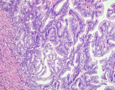 Mucinous borderline tumour (ovary) - MyPathologyReport.ca