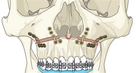 Le Fort Osteotomies | Le Fort Osteotomy I, II, III | Cost | Risks | Recovery