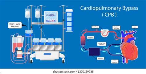 83 Cardiopulmonary Bypass Circuit Images, Stock Photos & Vectors ...