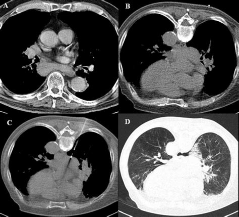 The biopsy of mass in posterior part of the mediastinum. Vascularized... | Download Scientific ...