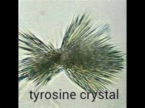 Bilirubin Crystal In Urine