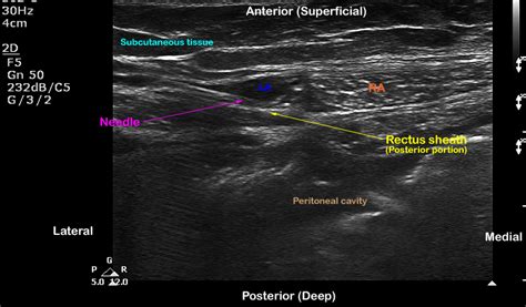 How I Do It: Ultrasound-Guided Bilateral Rectus Sheath Blocks