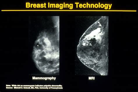 Mammogram Pictures With Descriptions of Different Results