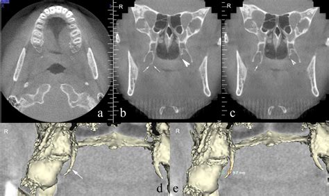 Pterygoid hamulus | Semantic Scholar