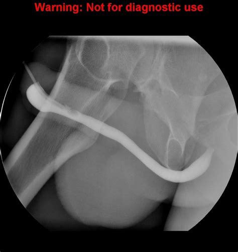 Normal retrograde urethrogram (RUG) and voiding cystourethrogram (VCUG) | Radiology Case ...