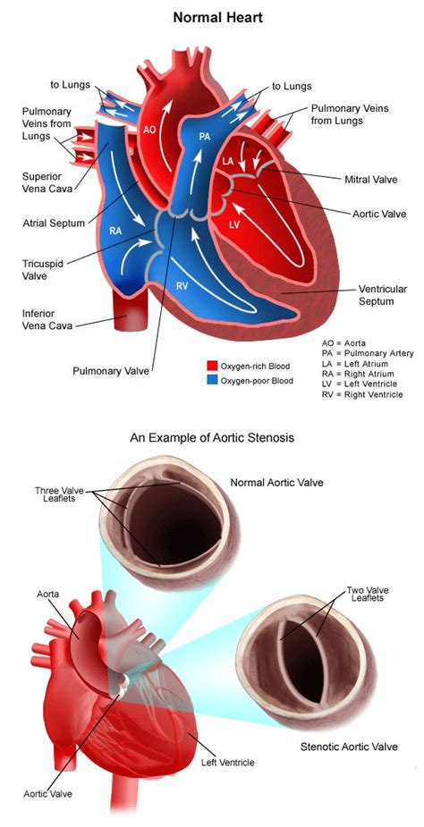 Aortic Stenosis - CHOC Children's