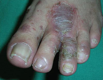 Painful rash on feet | MDedge Family Medicine