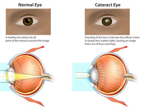 Is Cataract Surgery Necessary? | Blog